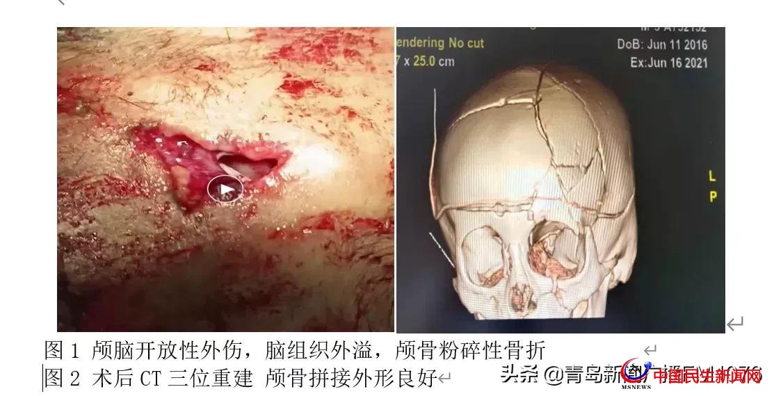 5歲男童6樓墜落命懸一線，婦兒醫(yī)院多學科協(xié)作再勝“死神”